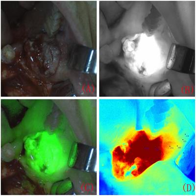 Near-infrared fluorescence imaging technology guided margin design in oral squamous cell carcinoma: a single-centre retrospective study